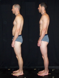 Rolfing SI Before and After Photo